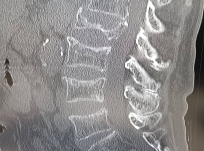 骨粗鬆症